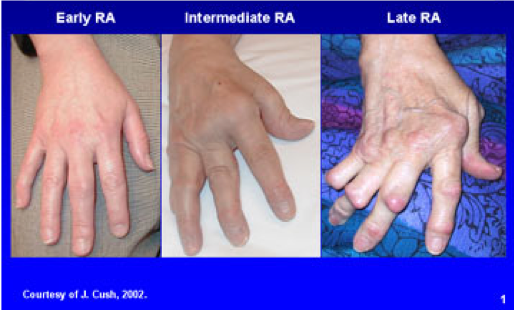 2b. Rheumatoid Arthritis (RA)